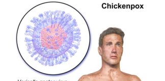 Facts-About-Chicken-pox