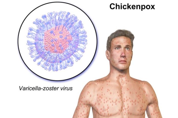 Facts-About-Chicken-pox