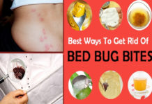 Best Home Remedies For Bug Bites In Children