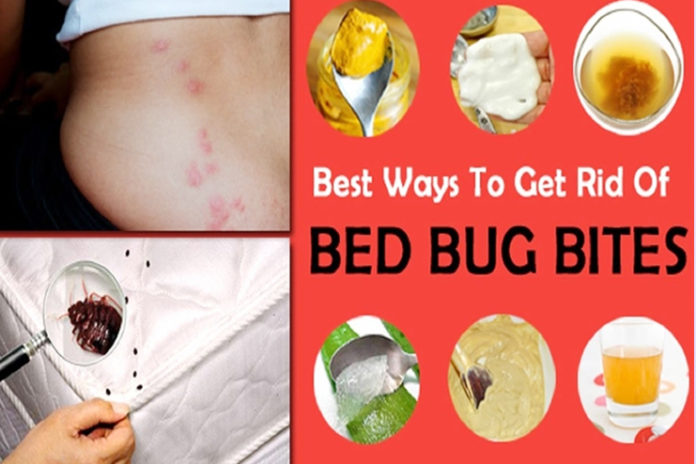 Best Home Remedies For Bug Bites In Children