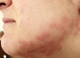 What do bed bug bites look like on skin