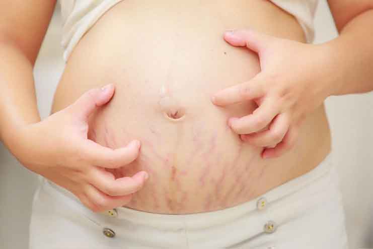 Itching-Skin-During-Pregnancy
