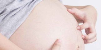 Stop-itching-during-pregnancy