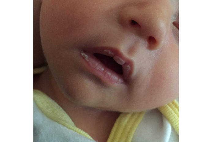 10 Home Remedies To Get Rid Of Chapped Lips In Babies