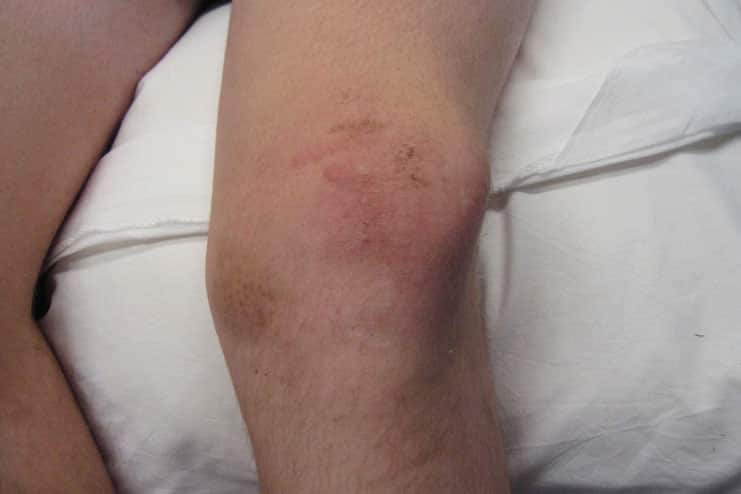 Symptoms-of-knee-Pain