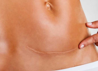 Reduce-belly-Fat-after-C-Section