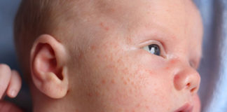 Toddler-acne