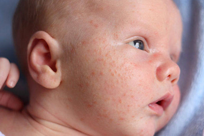 Toddler-acne