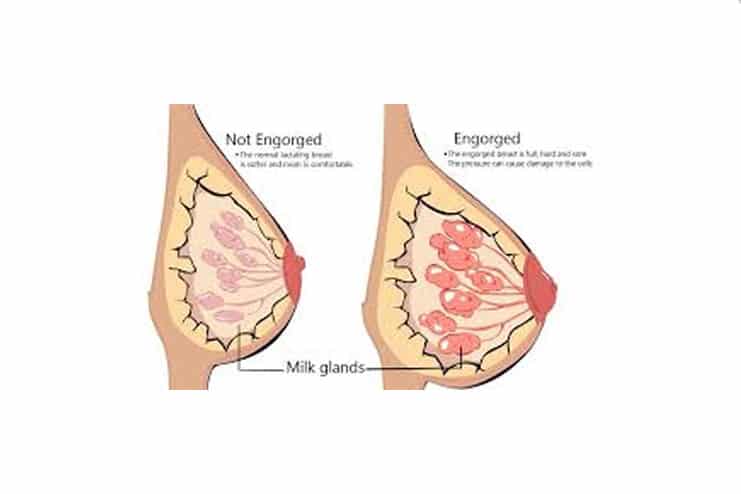 What-is-Breast-engorgement