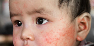 Summer-rashes-in-babies