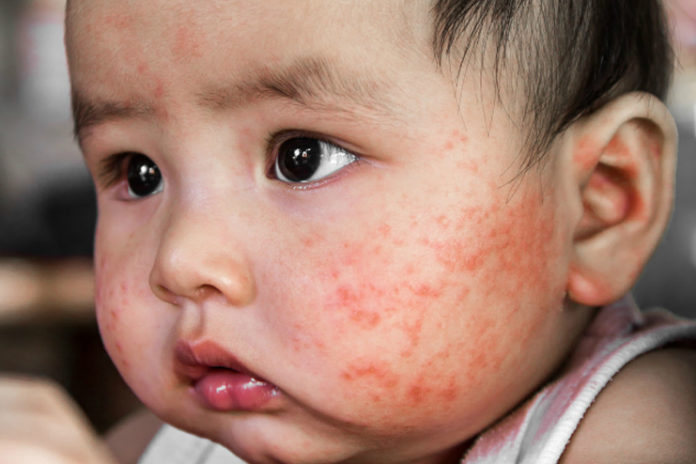 Summer-rashes-in-babies