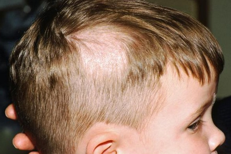 What-Causes-Childrens-Hair-To-Fall-Out